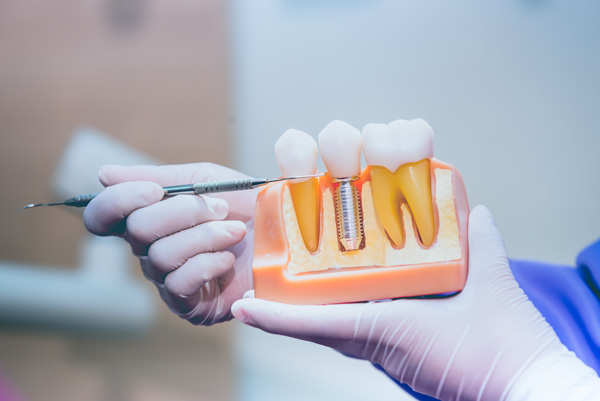 Image of dental professional pointing to a dental implant diagram, at Greashaber Dentistry in Ann Arbor, MI.