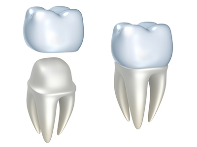 Image of a dental crown and parts of a dental crown, at Greashaber Dentistry in Ann Arbor, MI.
