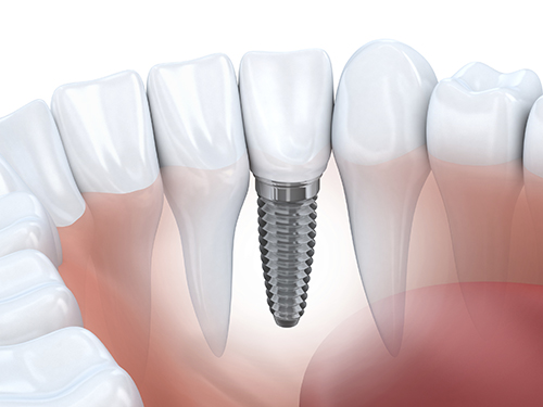 Dental implant restoration by dentist in Ann Arbor, MI.