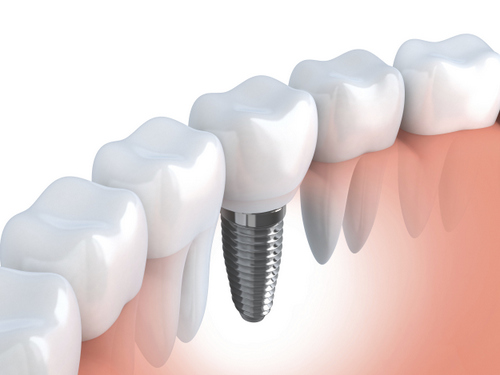 A rendering of a dental implant next to a tooth at Greashaber Dentistry in Ann Arbor, MI.