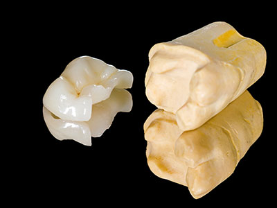 Dental inlays and onlays by dentist at Greashaber Dentistry Ann Arbor, MI.
