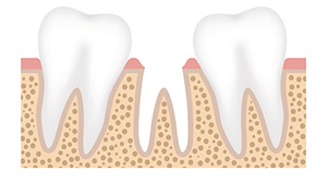 Missing tooth graphic before tooth socket graft from Greashaber Dentistry in Ann Arbor, MI