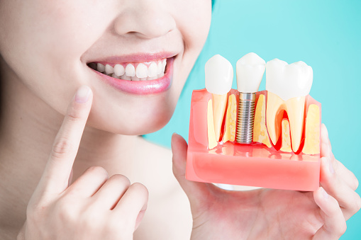 Image of a person pointing to her teeth and holding dental implant model, at Greashaber Dentistry in Ann Arbor, MI.