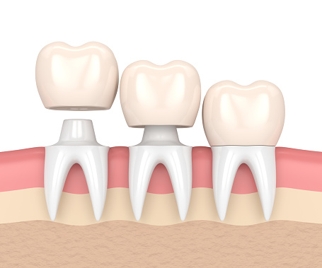 The progression of a dental crown being placed, at Greashaber Dentistry in Ann Arbor, MI.