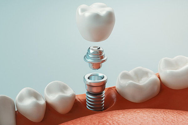 Image of a single tooth implant, at Greashaber Dentistry in Ann Arbor, MI.
