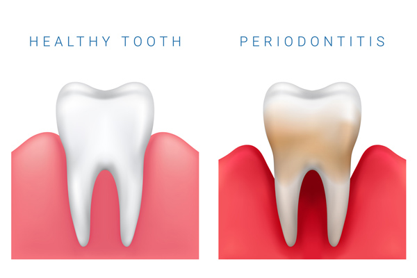 Graphic showing what dentists at Greashaber Dentistry in Ann Arbor, MI see before gum disease treatment